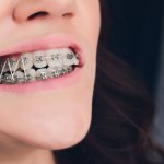 Vì sao thun liên hàm lại cần thiết cho quá trình niềng răng?