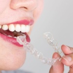 SO SÁNH: Niềng răng 3D Clear và niềng răng trong suốt AI