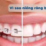 Niềng răng bị lệch mặt: Một số nguyên nhân và cách khắc phục