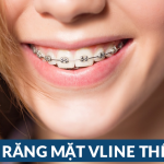 Niềng răng mặt VLine – Giúp răng đẹp và cằm thon gọn
