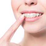 Top những thói quen xấu khi niềng răng bạn tuyệt đối nên tránh!