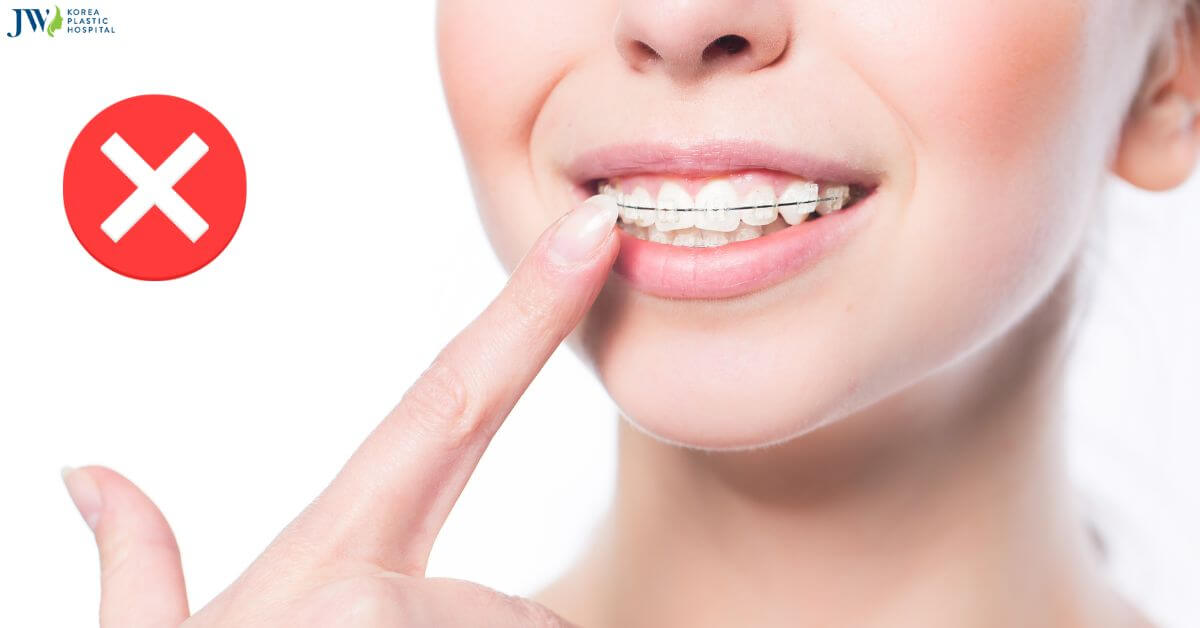 Top những thói quen xấu khi niềng răng bạn tuyệt đối nên tránh!