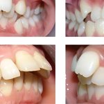 Nhổ răng vẩu trồng răng mới được không?