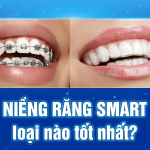 Niềng răng SMART loại nào tốt nhất?