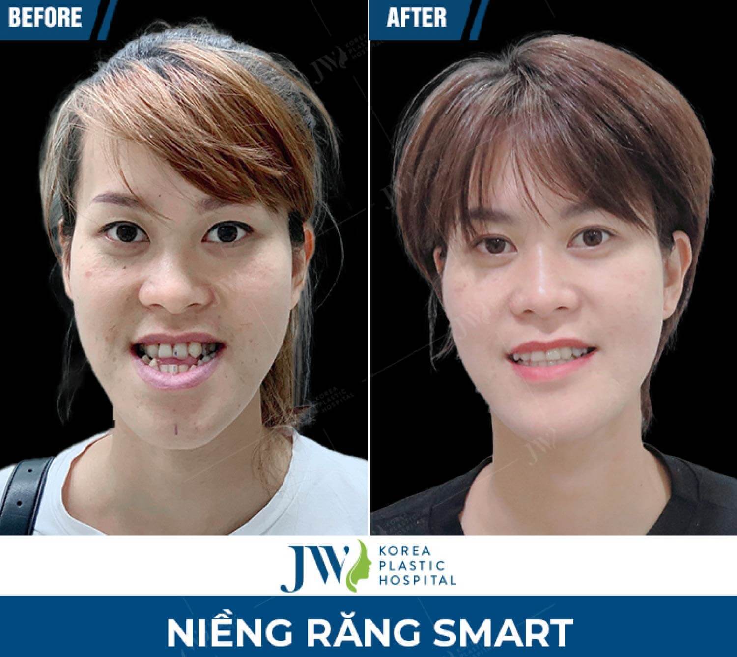nieng-rang-smart-jw-1