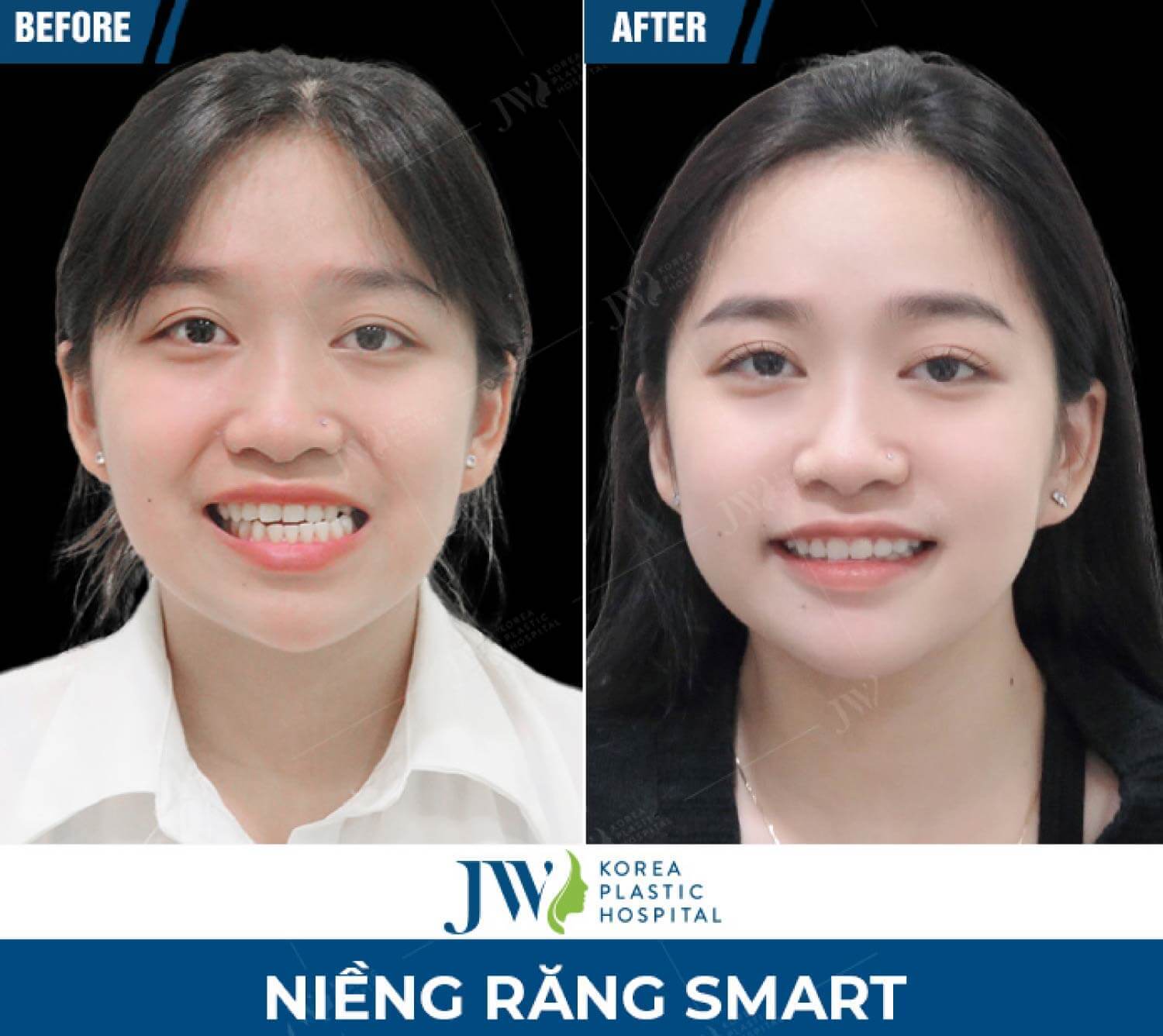 nieng-rang-smart-jw-2