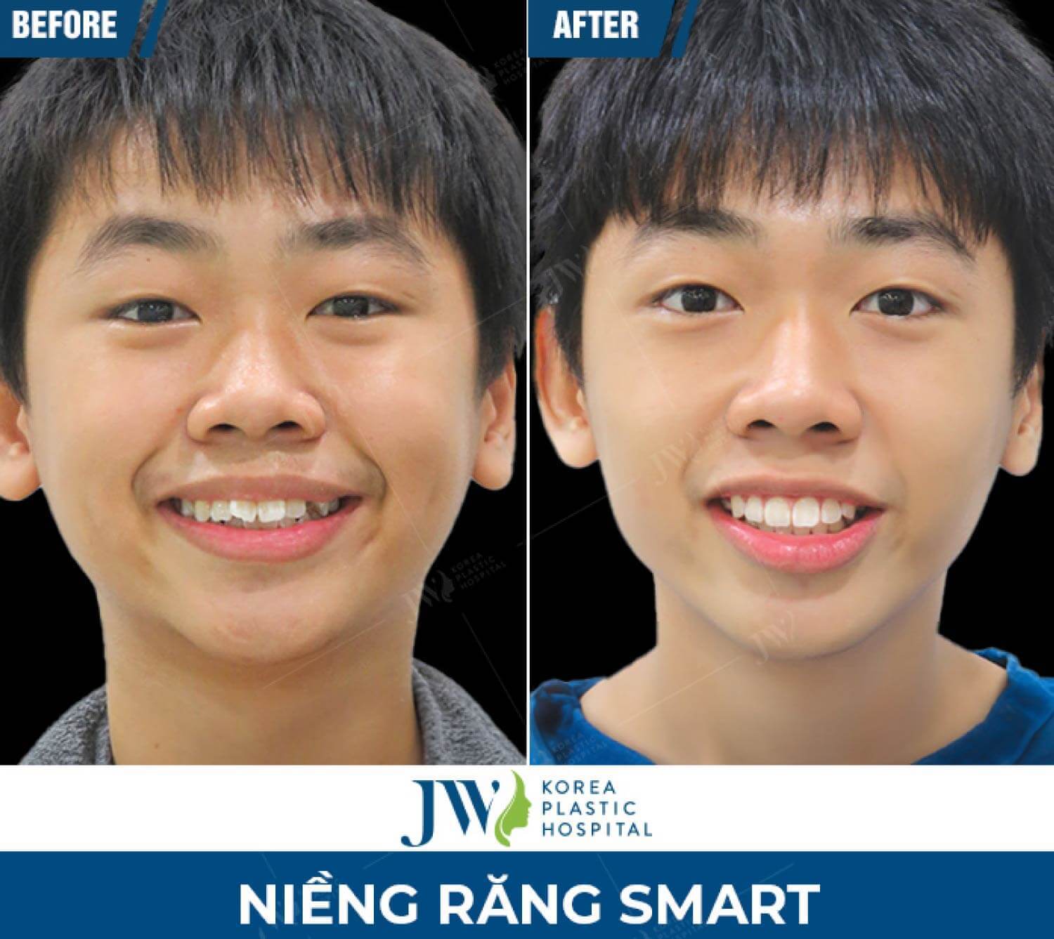 nieng-rang-smart