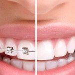 Top 4 lợi ích khi Niềng răng SMART có thể bạn chưa được biết