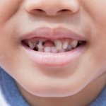 Bệnh răng miệng: Nguyên nhân và cách điều trị cho trẻ em
