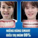 Niềng răng SMART có điều trị móm không? Hiệu quả ra sao?