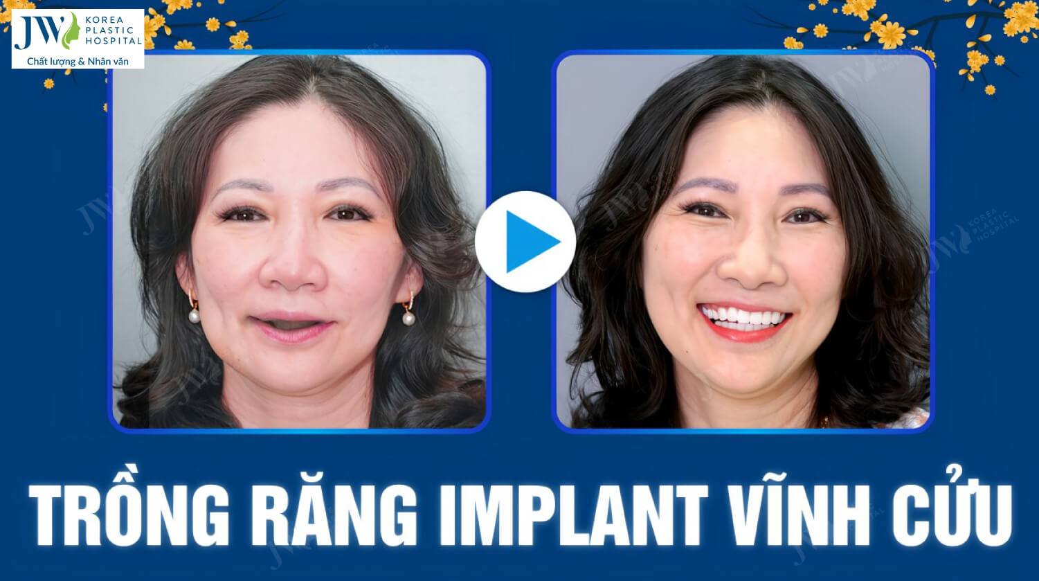 trong-rang-implant