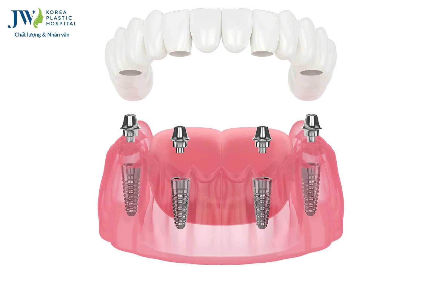 trong-rang-implant