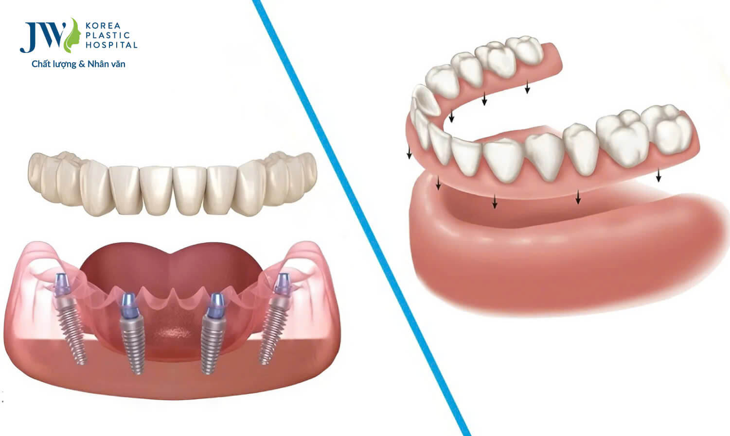 rang implant
