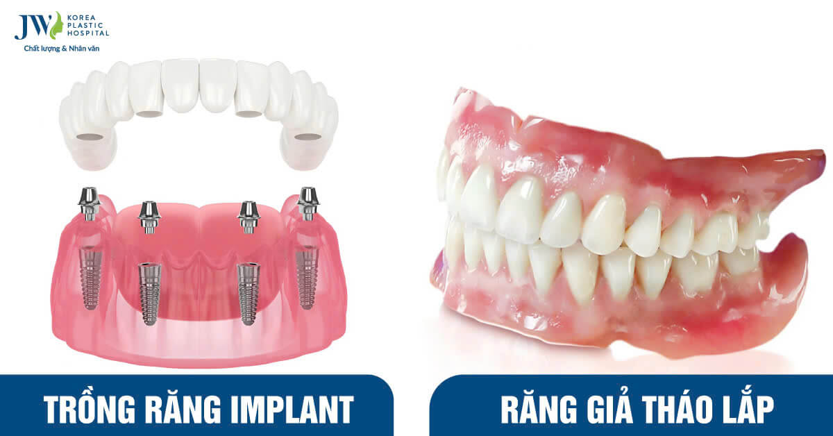 So sánh trồng răng Implant và răng giả tháo lắp cho người lớn tuổi