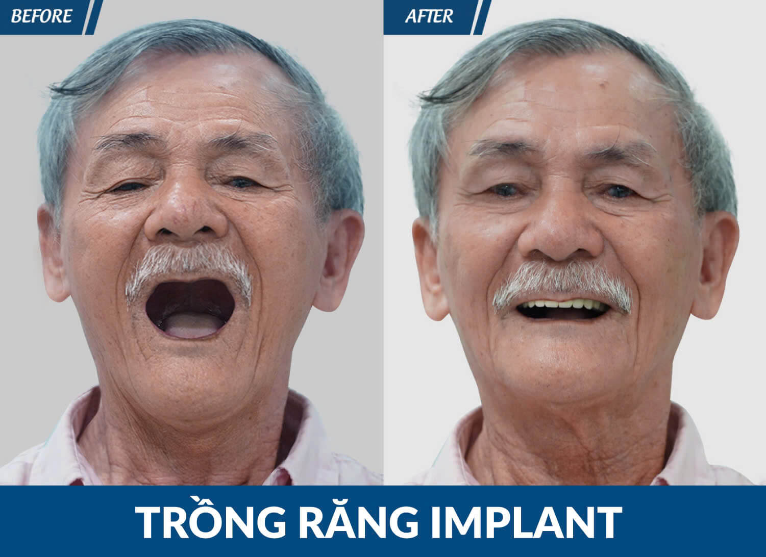 trong rang implant