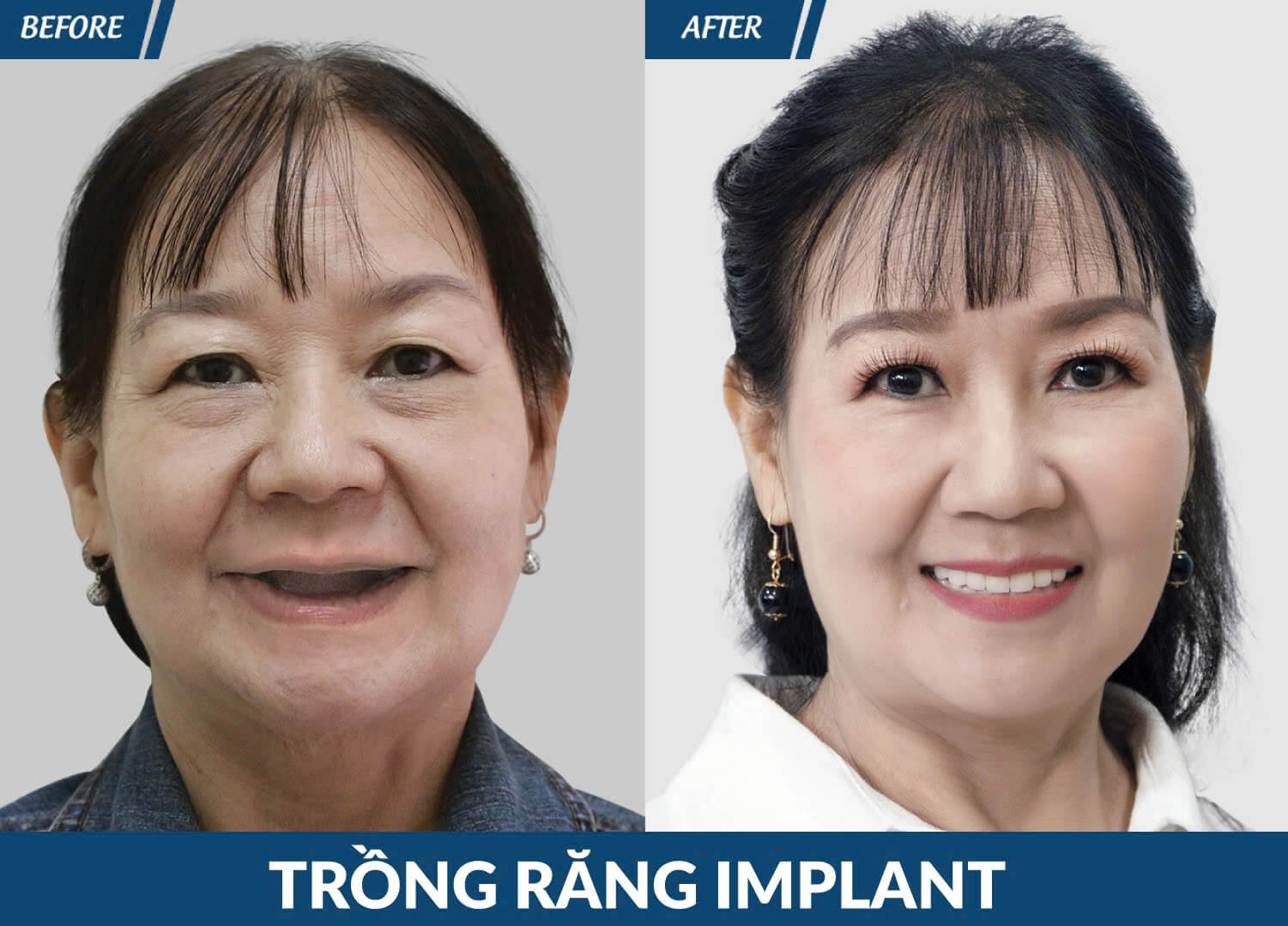 trong-rang-implant