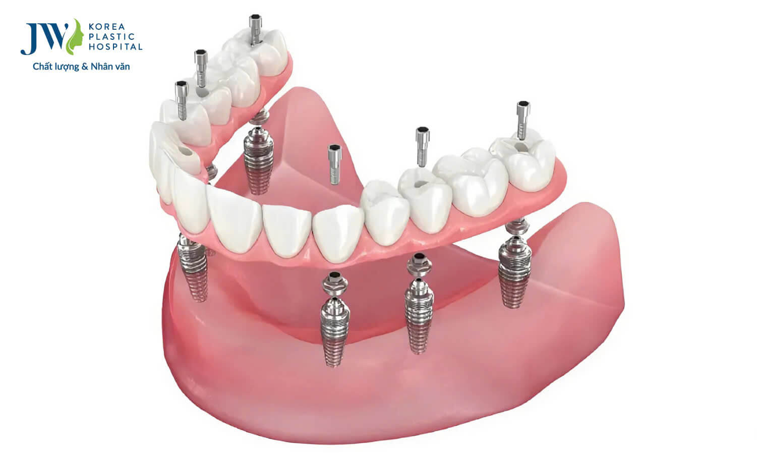 trong rang implant