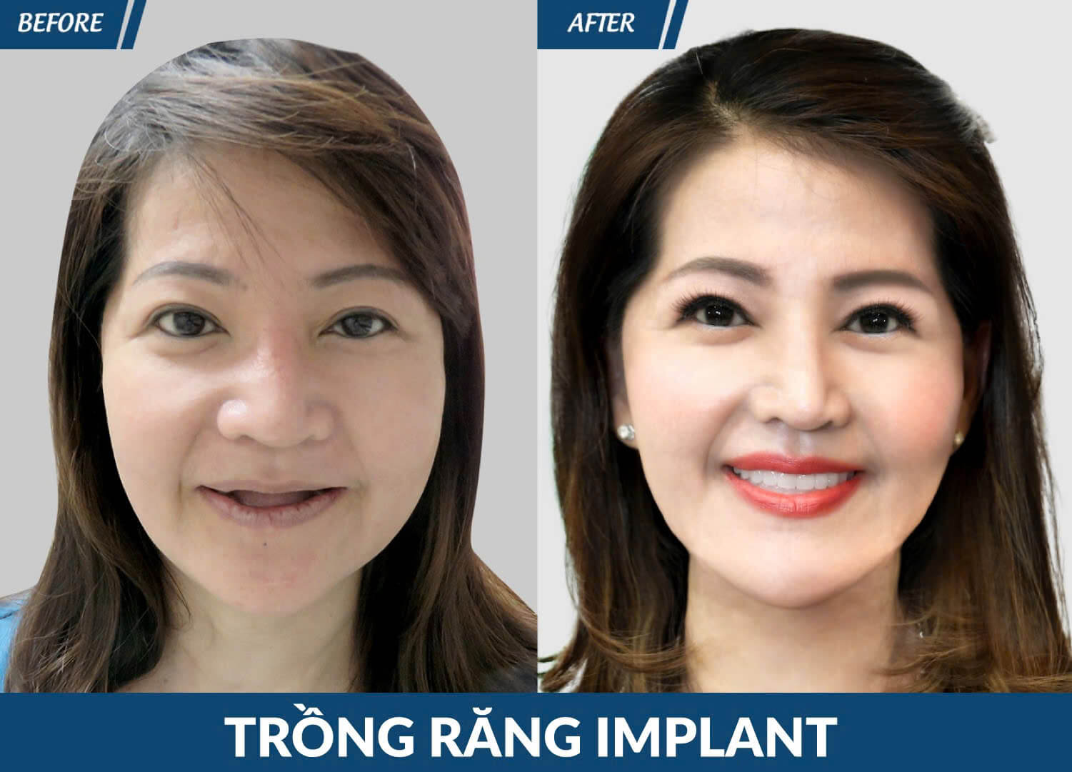 trong rang implant jw