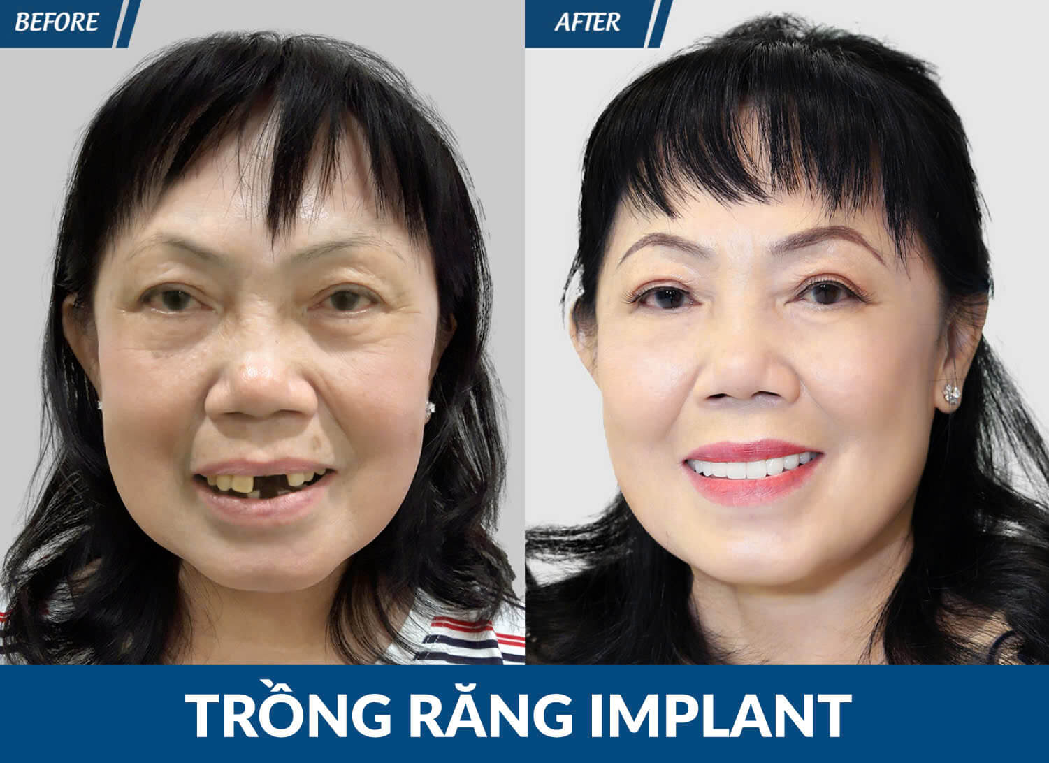 implant