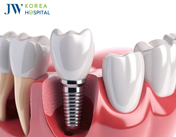 cam tru implant