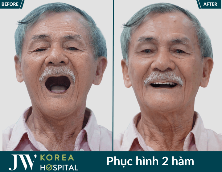 phuc hoi rang