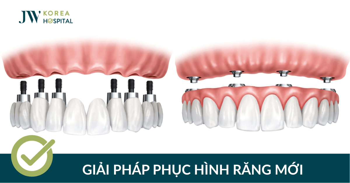 Phục hình răng mất lâu năm tại bệnh viện JW: nhanh chóng, bền đẹp, giá tốt