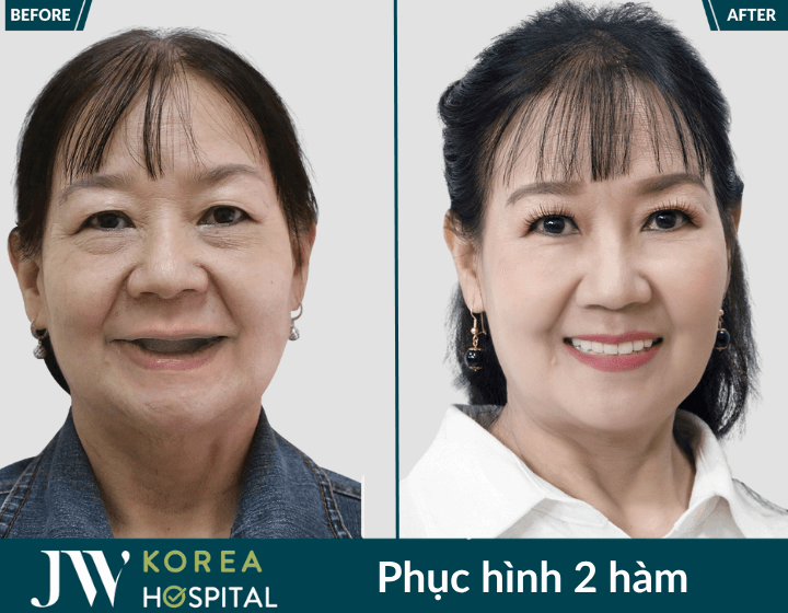 truoc va sau phuc hinh rang toan ham
