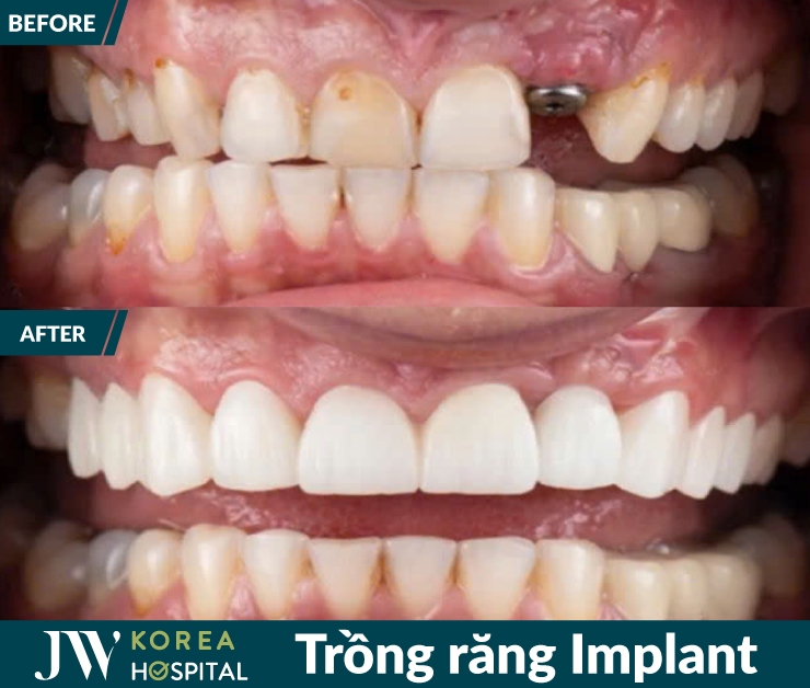 Kết quả trước và sau của khách hàng khi Trồng răng Implant tại JW