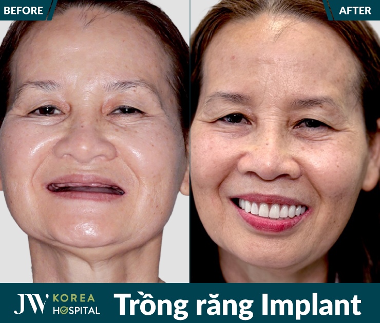 Cô chú U50 - U80 tự tin ăn ngon cười đẹp chỉ sau quá trình làm răng tại Bệnh viện JW