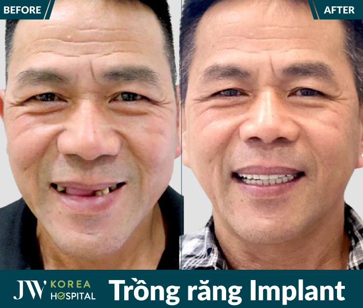 Khách hàng khôi phục răng mất, ăn ngon ngủ khỏe sau Trồng răng Implant tại JW