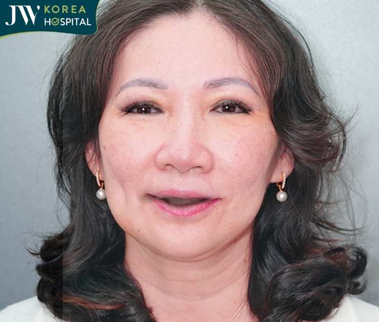 Giải quyết tình trạng mất răng của người cao tuổi với Trồng răng Implant tại JW