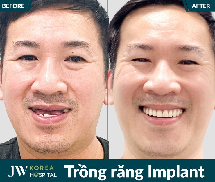 Trồng răng Implant tại Bệnh viện JW giúp cô chú mất răng lâu năm lấy lại nụ cười tự tin