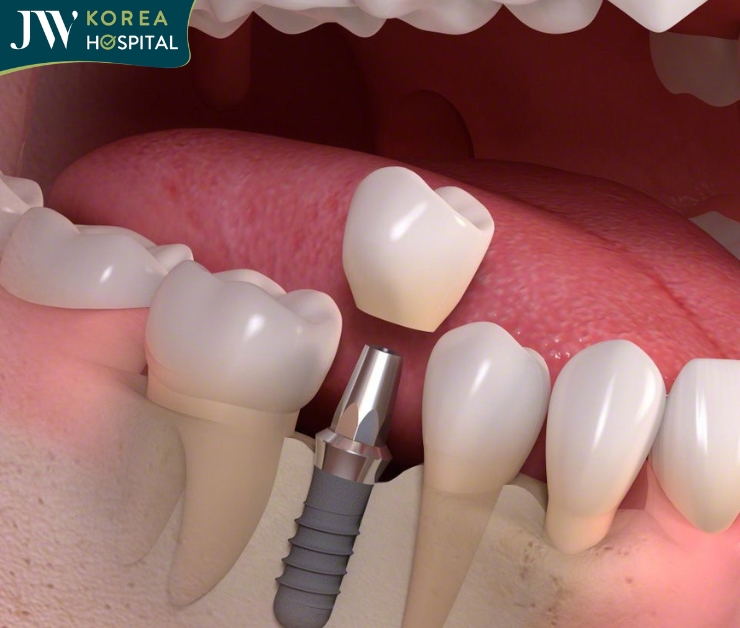 Phục hình răng mất, sở hữu nụ cười tự tin với Trồng răng Implant tại JW