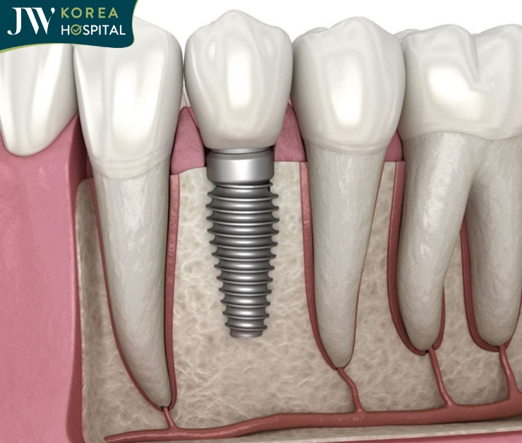 Bệnh viện JW trợ giá Trồng răng Implant chỉ từ 9.999 triệu